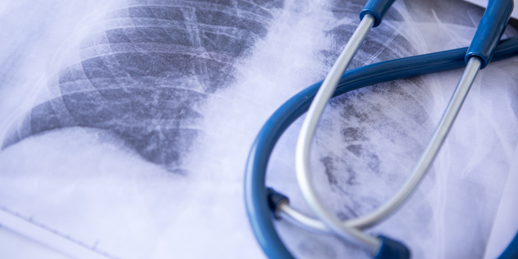 Lung Cancer Screenings Could Double, Is Your Program Prepared?